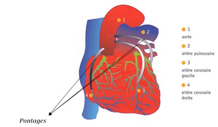 pontage coronaire