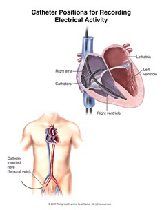 catheter_positions.jpg