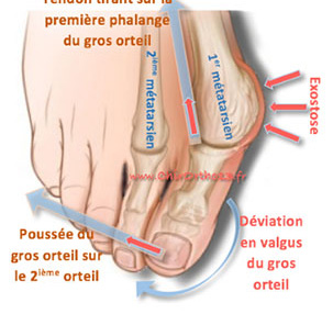 chir_hallux_2.jpg