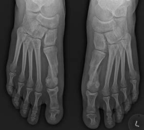 chir_hallux_9.jpg