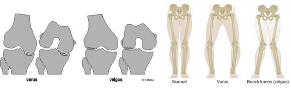 Chir_osteotomie_2.jpg