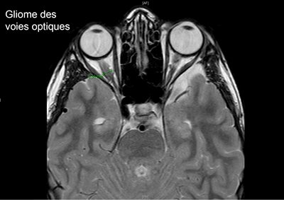 Imagerie-neurofibromatose.jpg
