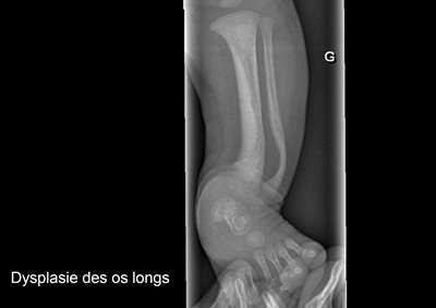 Imagerie-neurofibromatose4.jpg
