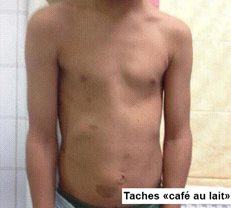 taches-cafe-au-lait-2-legende.jpg