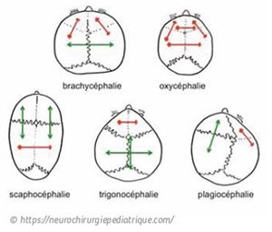 cranio-stenoses.jpg